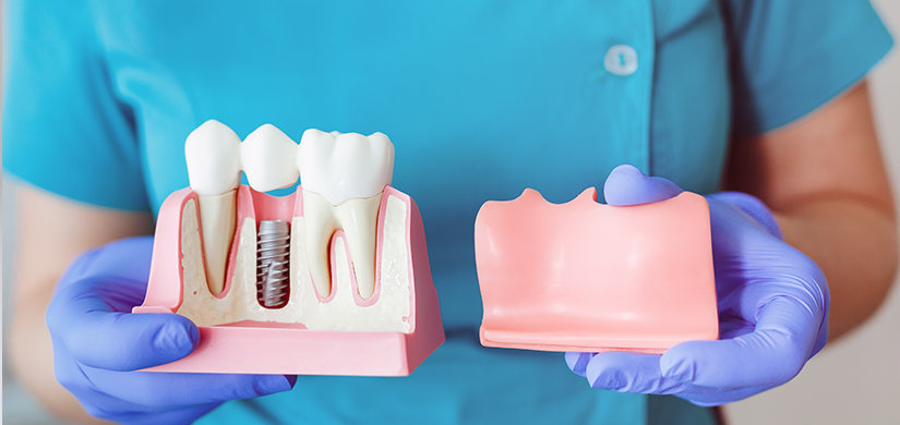 Dental Implants